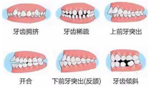 小孩儿做窝沟封闭多少钱,窝沟封闭收费和免费的区别(图1)